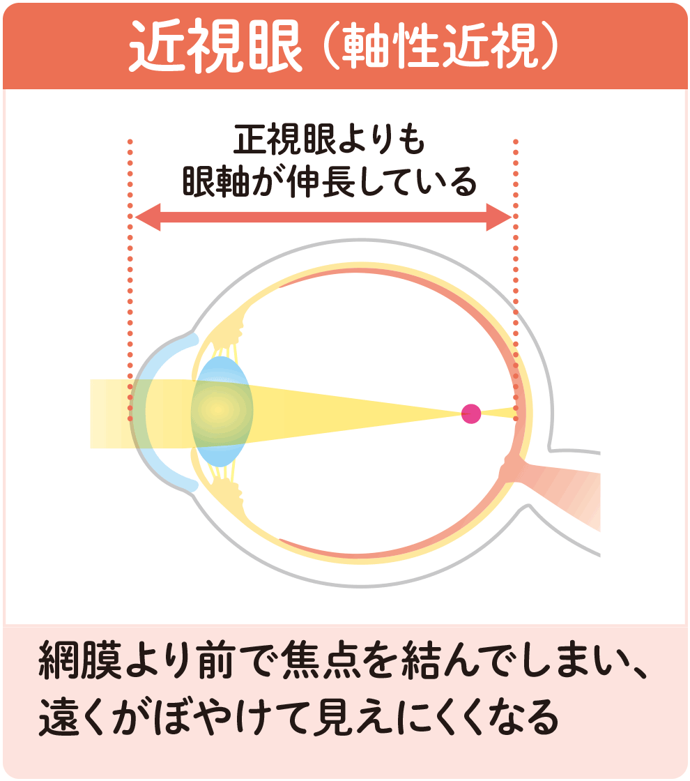 近視眼