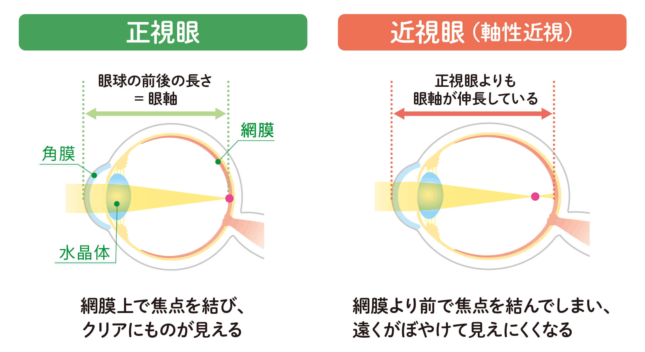 正視眼と近視眼